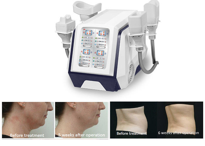 เครื่องกระชับสัดส่วน 360 Cryolipolysis แบบพกพา 1000W สำหรับการลดน้ำหนักที่เผาผลาญไขมัน