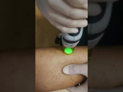 GentleLase Pro 755nm Alexandrite Laser Hair Removal