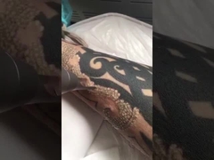 เครื่องเลเซอร์ pico วินาทีสำหรับการลบรอยสัก